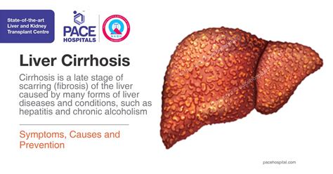 Liver Cirrhosis - Symptoms, Causes and Prevention