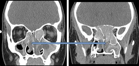 Fungal Sinusitis - SinusHealth.com