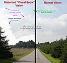 Visual snow - Wikipedia