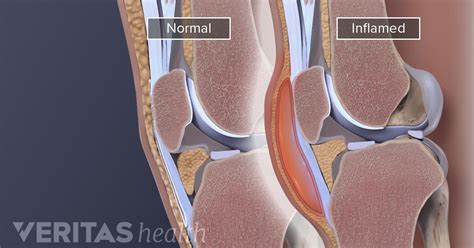 Incision And Drainage Of Olecranon Bursitis Cpt Code - Best Drain Photos Primagem.Org