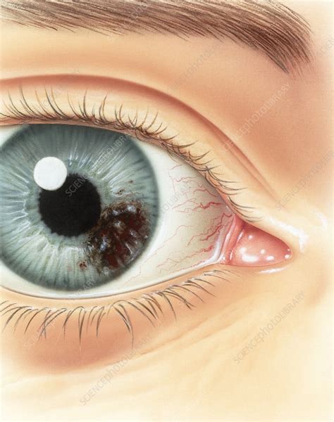 Melanoma of the iris, illustration - Stock Image - C029/0645 - Science ...