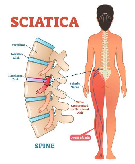 Lower Back Muscles Diagram Pain