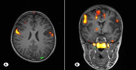 During the functional MRI performed for the cerebral lesion located in ...