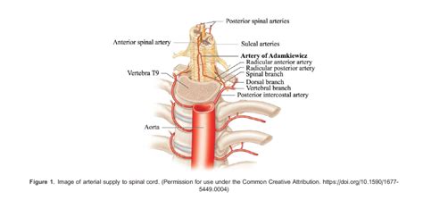 Lumbar Spinal Drains for Thoracoabdominal Aortic Surgery : WFSA - Resources