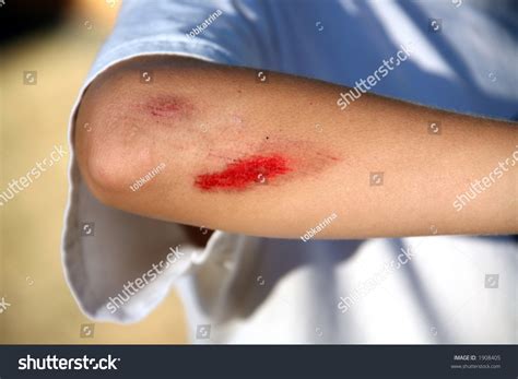 Young Child With Bloody Scrape On Arm Stock Photo 1908405 : Shutterstock