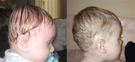 Ben's Brachycephaly Journey