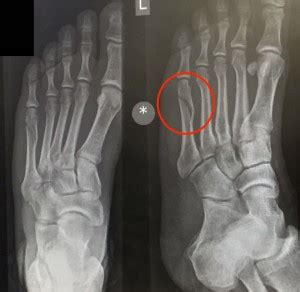 Breaking my 5th Metatarsal Bone - Spiral Fracture - KFFKR InsightsKFFKR ...