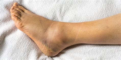 12 Causes of Swollen Ankles, Feet - Why Are My Ankles Swollen