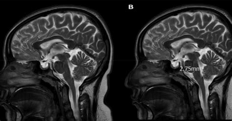 Idiopathic Intracranial Hypertension Mri