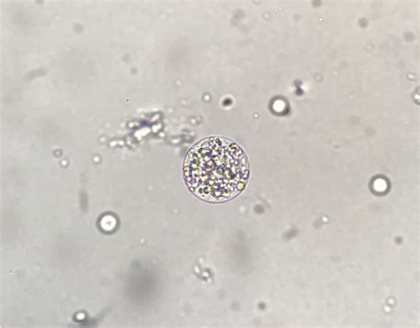 Cells In Urine Sediment : Atypical Transitional Epithelial Cells | Clinician's Brief - Urine ...