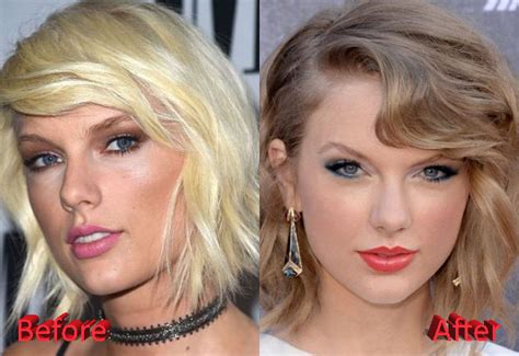 Taylor Swift Plastic Surgery Before and After