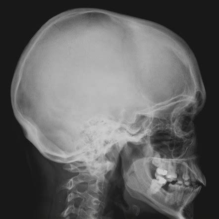 Skull (lateral view) | Radiology Reference Article | Radiopaedia.org