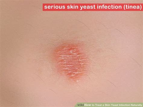 How to Treat a Skin Yeast Infection Naturally | How to do it