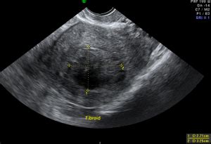 Chapter 41 – Hysteroscopic Removal of Fibroid (Transcervical Resection ...