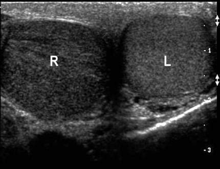 Normal Epididymis Ultrasound