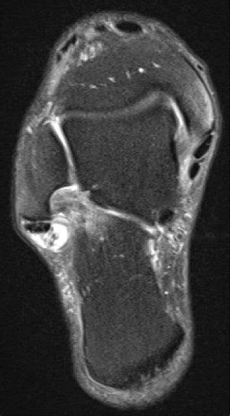 Rupture of the peroneus brevis tendon (MRI oblique axial view). | Download Scientific Diagram