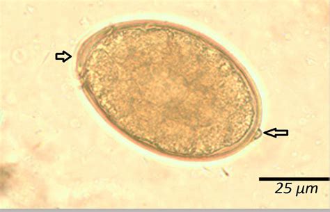 Diphyllobothrium latum – Egg – Parasitology