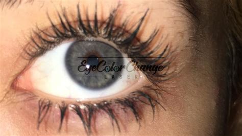 eye color change laser turkey | Eye Color Change Turkey | Premium Laser Technology