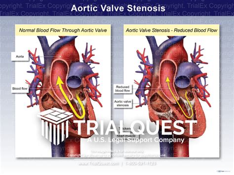 Aortic Valve Stenosis - TrialExhibits Inc.