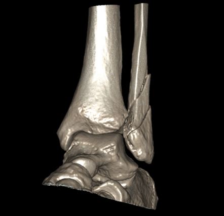 Weber classification of ankle fractures | Radiology Reference Article ...