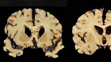 Aaron Hernandez Cte Brain Scan