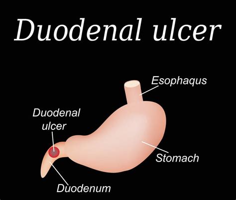 #1 Duodenal Ulcer - Symptoms And Causes