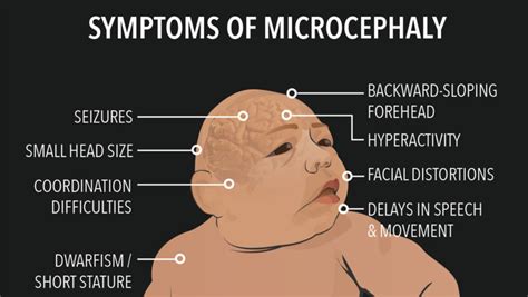 Is Zika the real cause of microcephaly in Brazil? New study raises questions