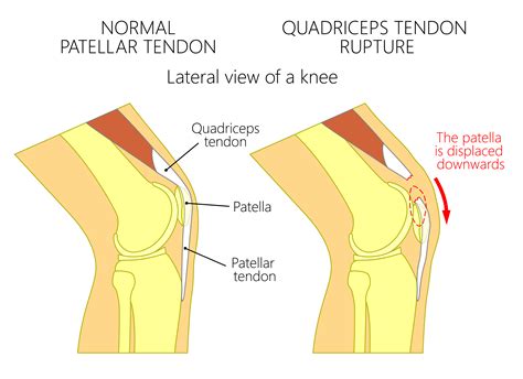 Knee extensor mechanism - Dubai Sports Orthopaedics