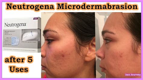 NEUTROGENA MICRODERMABRASION Review (before & after) - YouTube