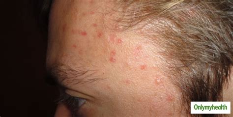 Hairline Acne: What Is This and How This Can Be Treated | OnlyMyHealth