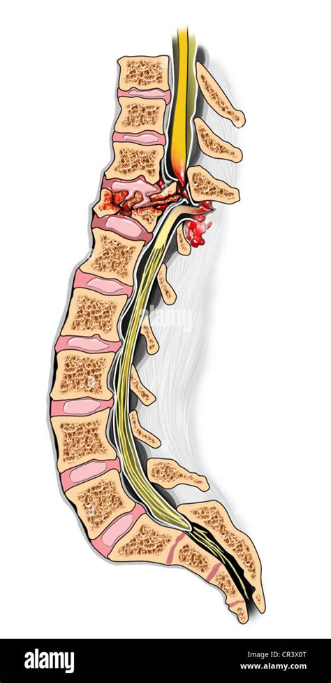 T12 Burst Fracture with Complete Spinal Cord Injury Stock Photo ...