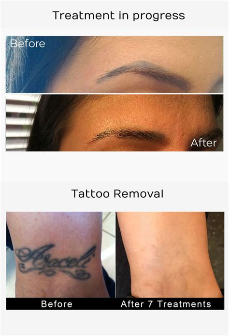 Tattoo Removal Los Angeles - Laser Tattoo Removers