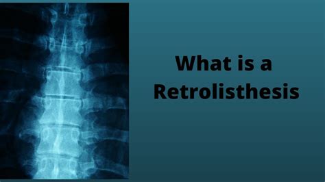 What is a Retrolisthesis - YouTube