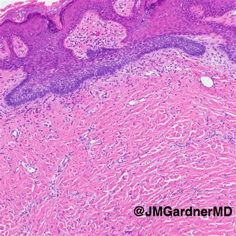 Dermatofibroma Histology