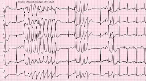 Torsades de pointes electrocardiogram - wikidoc