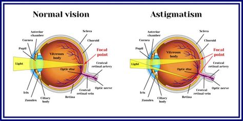 LASIK for Astigmatism – Success Rates, Costs & Recovery