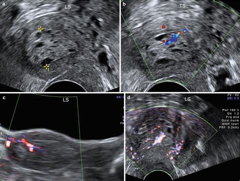 Ultrasound Evaluation of Endometrium | Obgyn Key