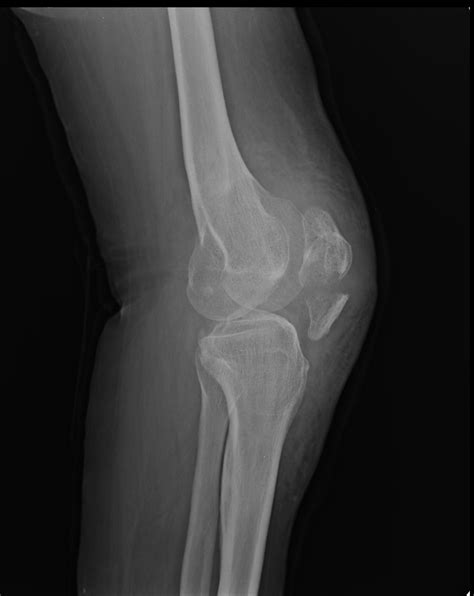 Patella fracture | Image | Radiopaedia.org