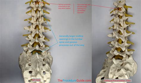 Lumbar/Thoracic Epidural Catheter Insertion – Technique and Overview - The Procedure Guide