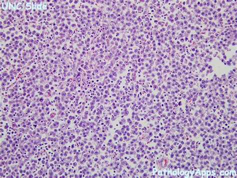 seminoma pathology