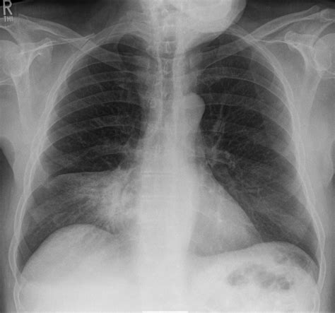 Röntgenzeichen – Wikipedia