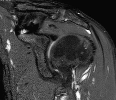 MRI using the standards described for viewing the coracoclavicular ...