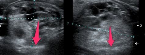 Papillary thyroid cancer echocardiography or ultrasound - wikidoc