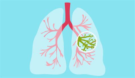 cystic fibrosis prognosis after lung transplant Archives - Avens Blog ...