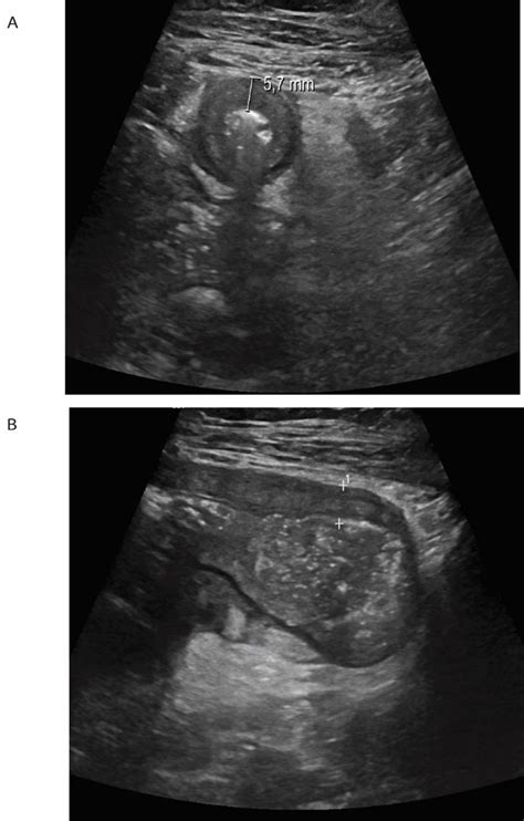 External abdominal ultrasound (US) of the terminal ileum. (A) External ...