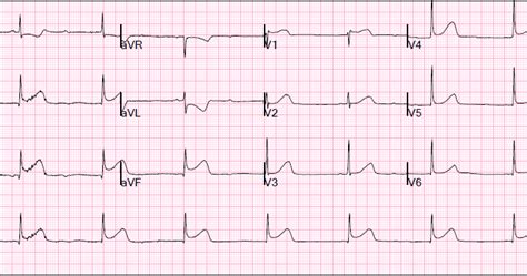 Dr. Smith's ECG Blog: Inferior STEMI with AV Block, Cardiogenic Shock ...