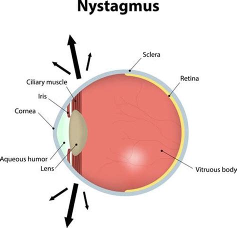 Nystagmus: Causes, Symptoms & Effective Treatment – NVISION