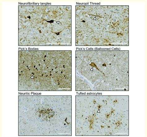 Features of tau pathology in human FTLD-tau. Immunohistochemical... | Download Scientific Diagram