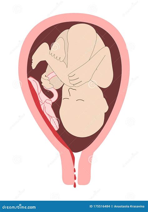 Child in the Womb. the Detachment of the Placenta, Placental Abruption ...