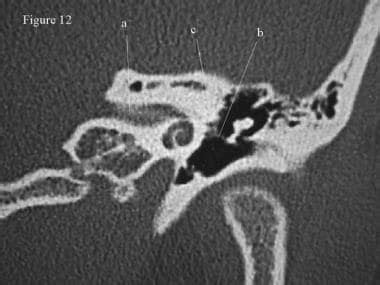 Ct Scan Temporal Bone Anatomy